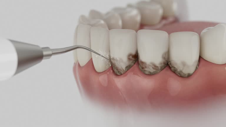 Trusted Dental Crowns And Bridges service in Solon, OH - Dentist Open Now